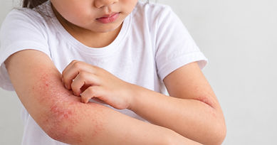 Eczema Treatment in Kota Kinabalu