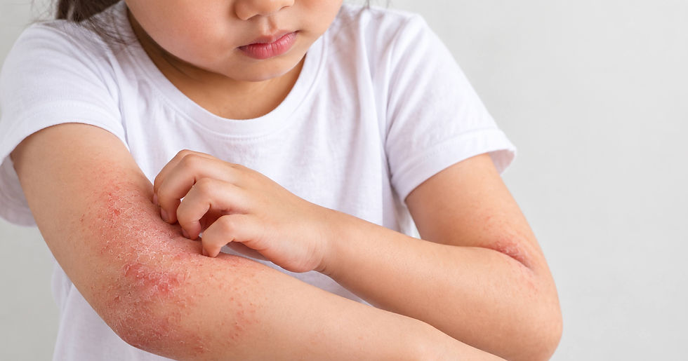 Children's Eczema: A Guide for Parents