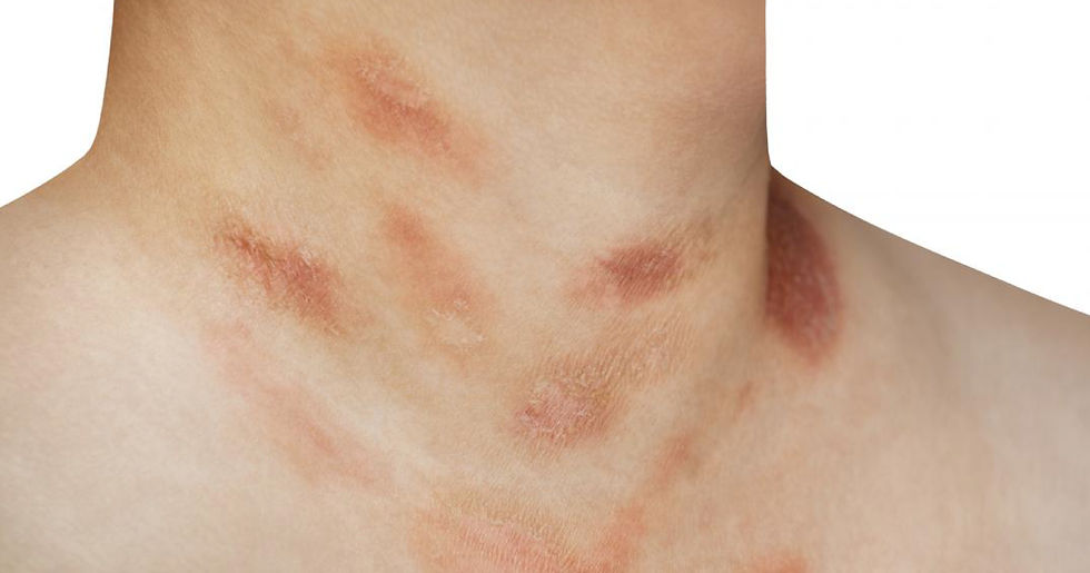 5 Psoriasis Mistakes You're Probably Making