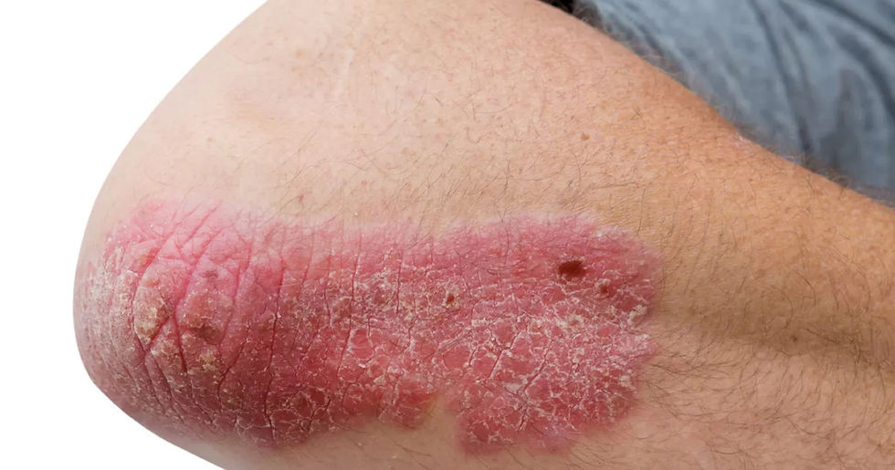Rawatan Psoriasis di Kota Kinabalu