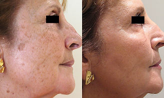 ipl face treatment