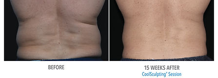 coolsculpting fat freezing procedure
