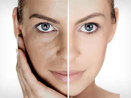 Combining Toxin, Soft Tissue Filler & Threads: Achieving the Best Result for Facial Rejuvenation