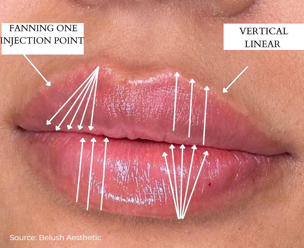 5 Popular Injection Techniques of Lip Augmentation