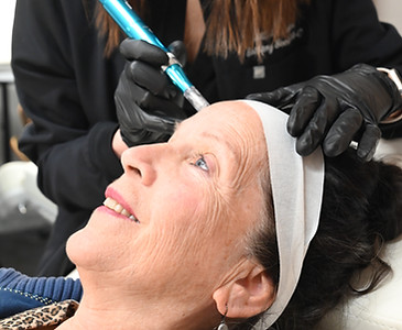 A patient getting microneedling in Phoenixville, PA for wrinkles