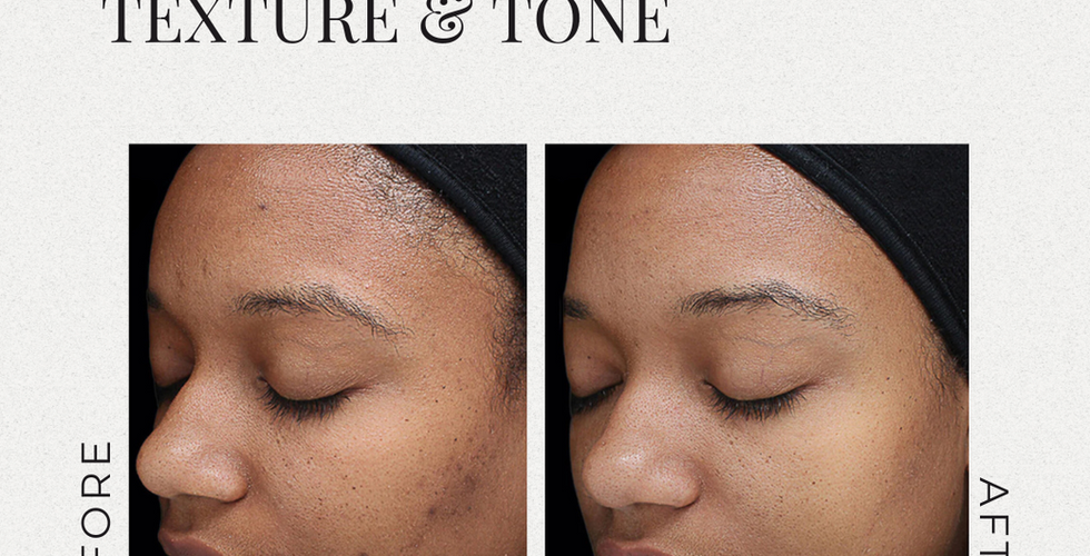 chemical peel columbia mo