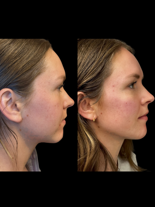 Cheek and Chin Filler in Omaha NE