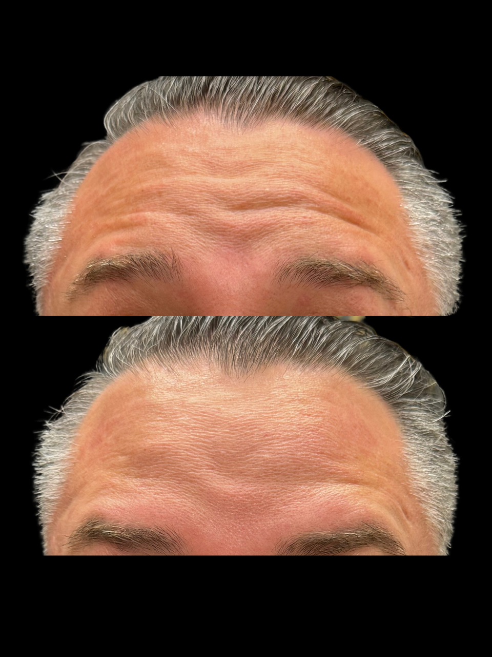 Best Botox injector Omaha