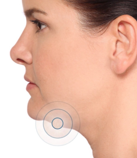 Kybella Treatment