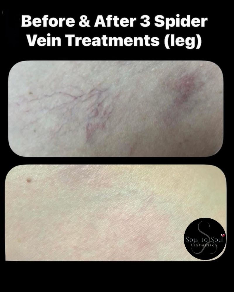 Spider Vein Removal from legs Treatment In Lebanon TN