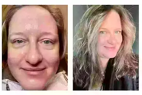 PRP w/Microneedling Facal