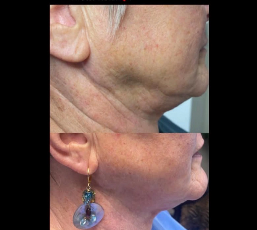 Radiesse Neck Rejuvenation Lebanon_edited.png