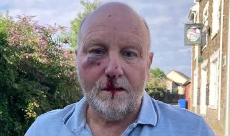 Christopher Lavis after being assaulted for driving at the 20mph speed limit