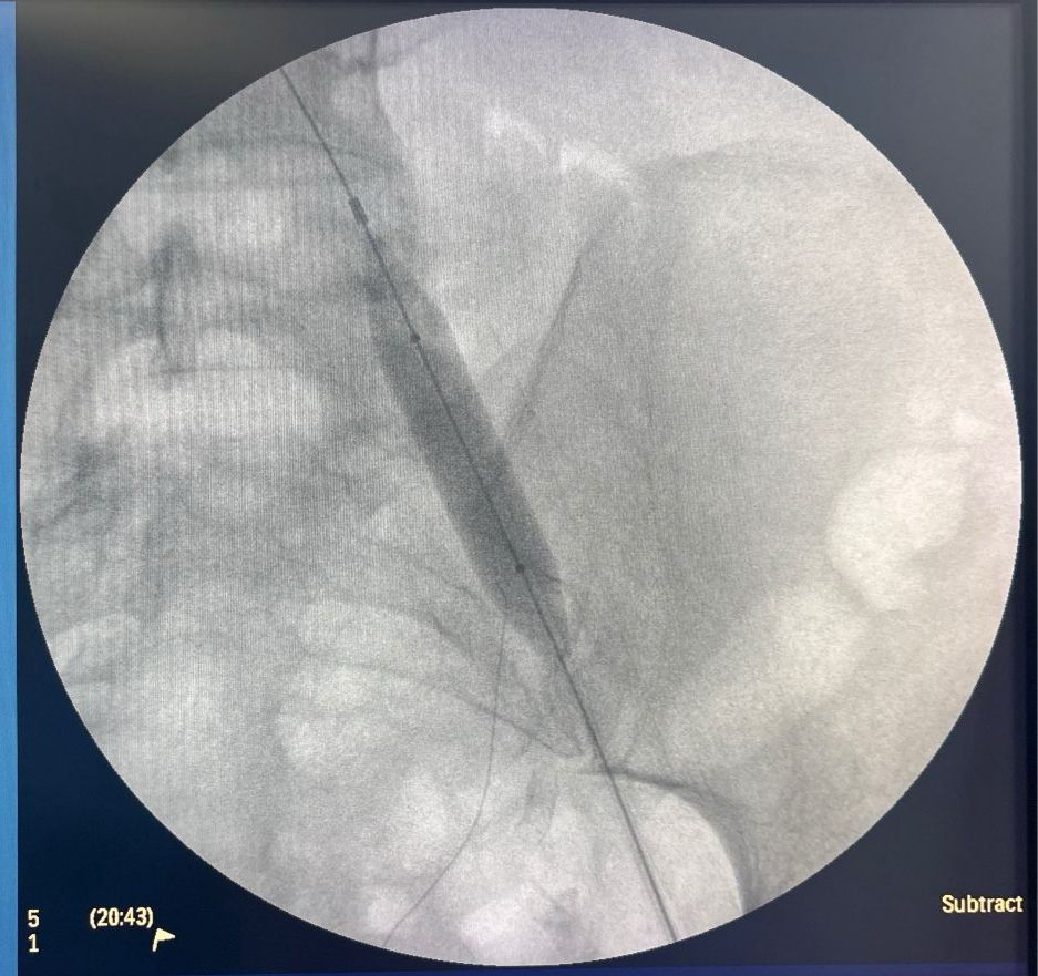 Recanalização venosa em paciente renal crônica: abordagem endovascular com Venovo e Conquest