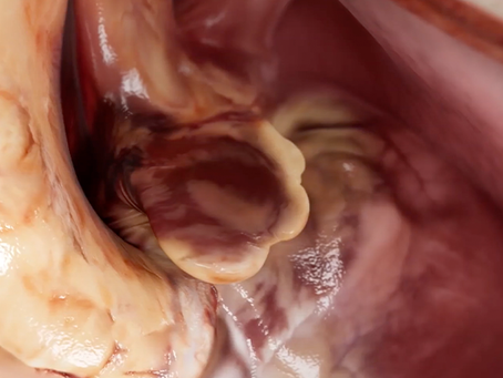 90% dos Trombos na Fibrilação Atrial se Formam no Apêndice Atrial Esquerdo. O Que Isso Significa para a Prevenção do AVC?