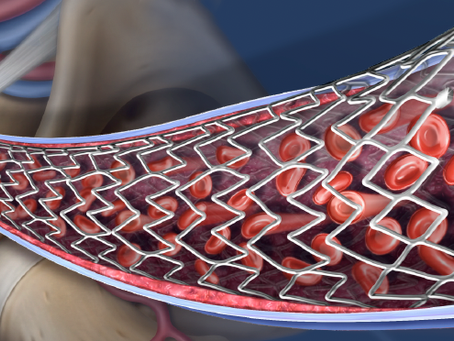O que o stent de nitinol pode fazer por quem já teve trombose