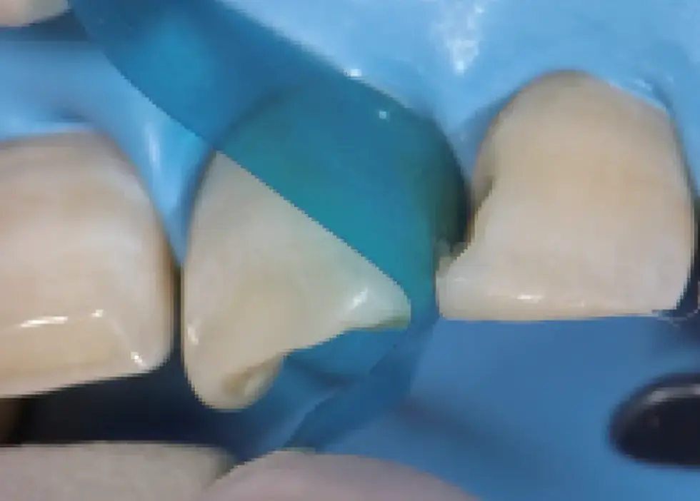Thumbnail: Contoured Anterior Matrix M8
