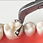 Thumbnail: Sectional Matrix Bands M4 1.0