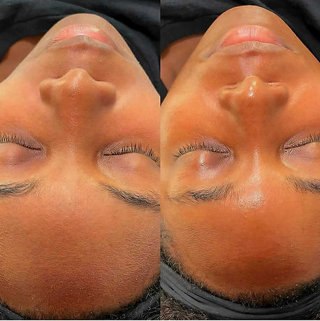 Before and after facial