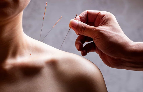 concerns-about-acupuncture-therapy-acupuncture-shoulder.jpg