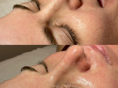 Dermaplane + AFA Gel Peel + Jelly Mask Treatments to revive this beauty's skin.