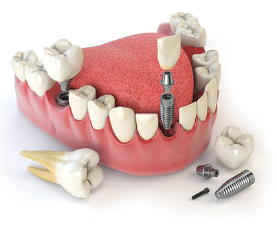 Implante Dentário Porto Alegre