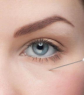 Redução de Olheiras