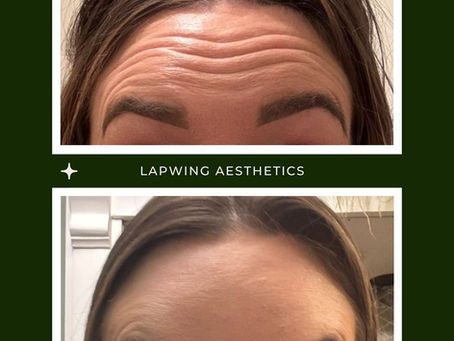 botox forehead lapwing aesthetics gorleston great yarmouth bradwell