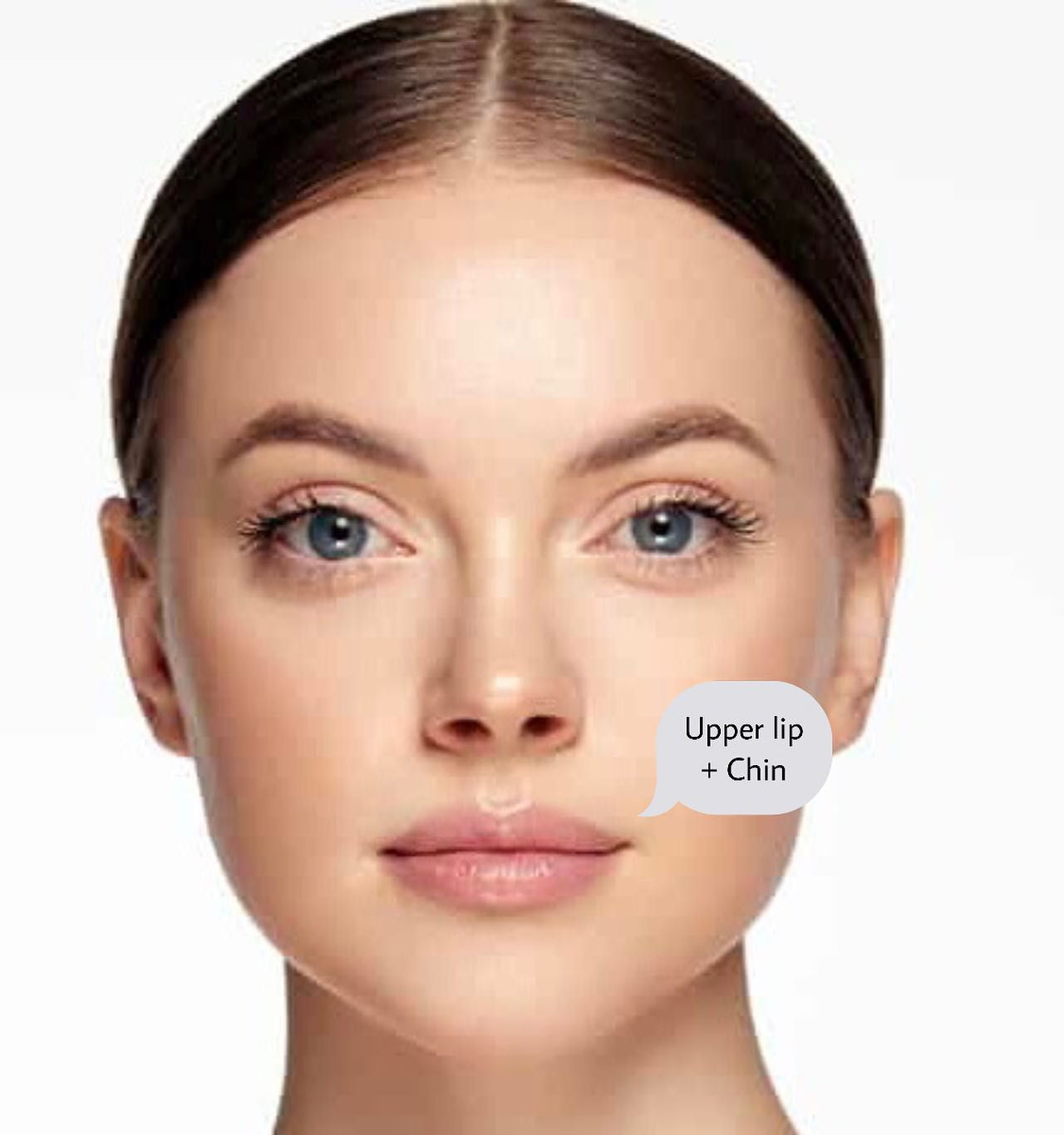 Upper Lip+Chin LASER HAIR REMOVAL