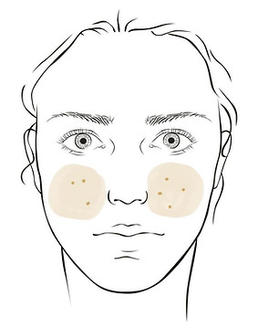 Laser Göttingen Akne