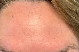 Wrinkle Relaxer Injections (Botox) 1_edited.jpg
