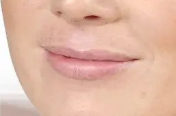 Dermal fillers before.webp