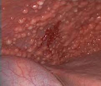 Carcinomatose peritoneal cirurgia citorredução HIPEC cirurgião oncológico Belo Horizonte especialista