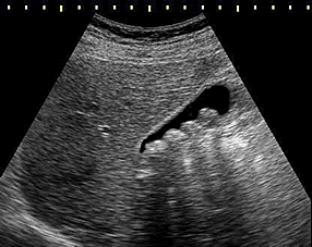 pedra VESICULA CIRURGIA colecisitite