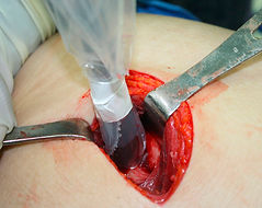 MELANOMA CIRURGIA ONCOLOGICA BH