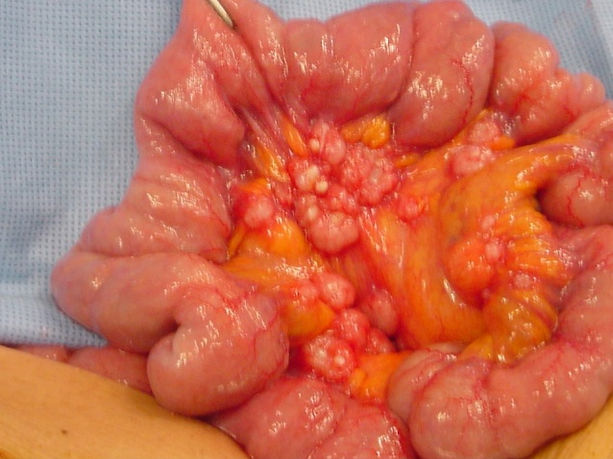 carcinomatose peritoneal HIPEC