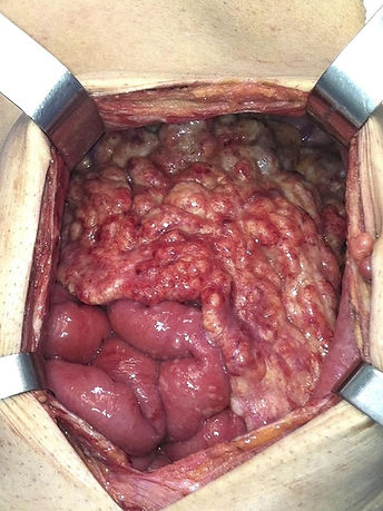 carcinomatose peritoneal HIPEC
