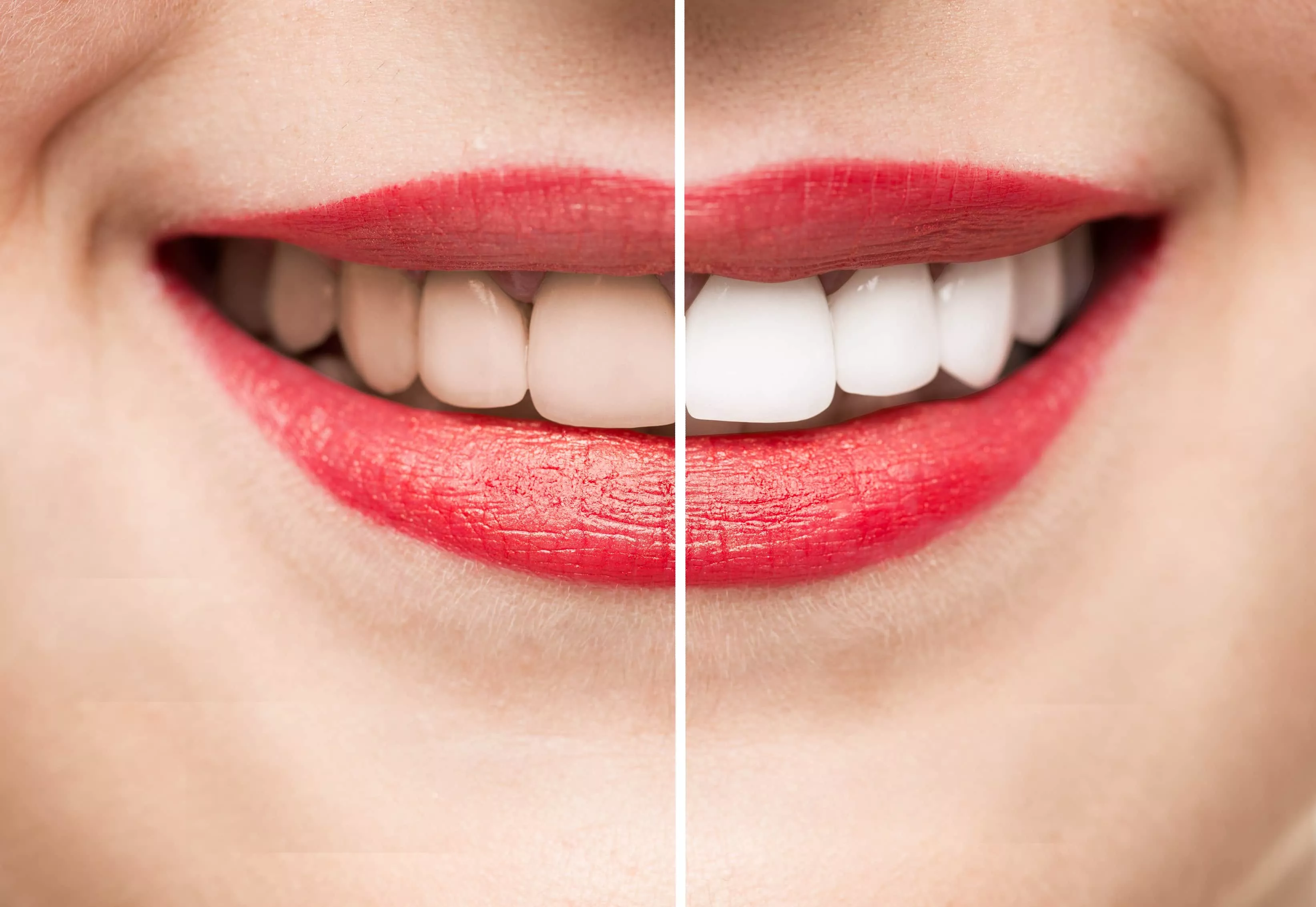 teeth-whitening-service-renton-wa.webp