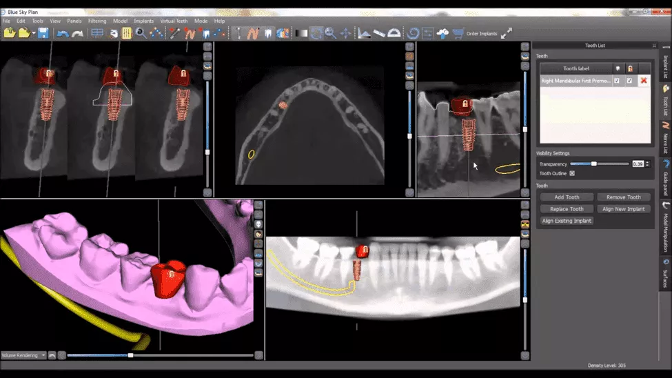 3D-Implant.webp