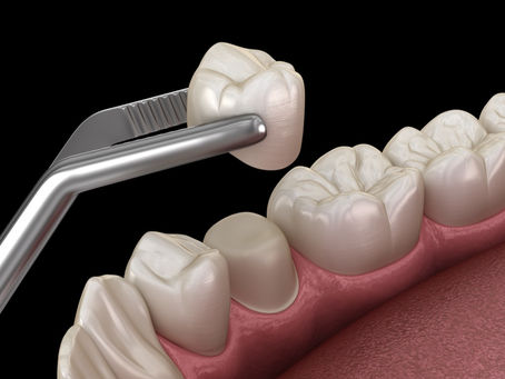 Dental Crowns Near Me in Richmond