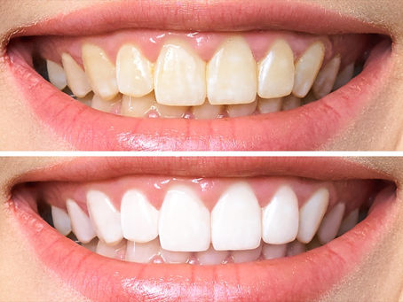 Professional In-Office Teeth Whitening | Richmond VA