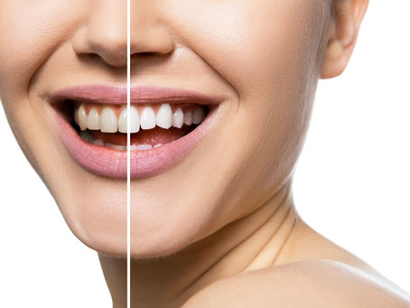 Teeth Whitening Treatment in Richmond