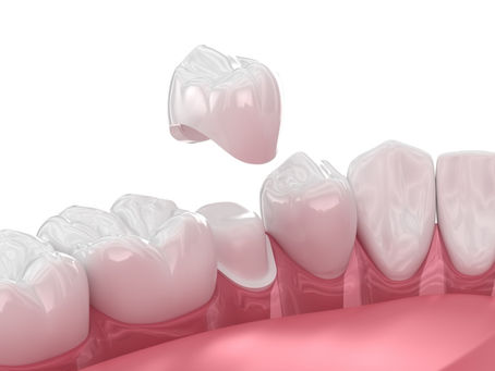 Dental Crowns Near Me in Richmond