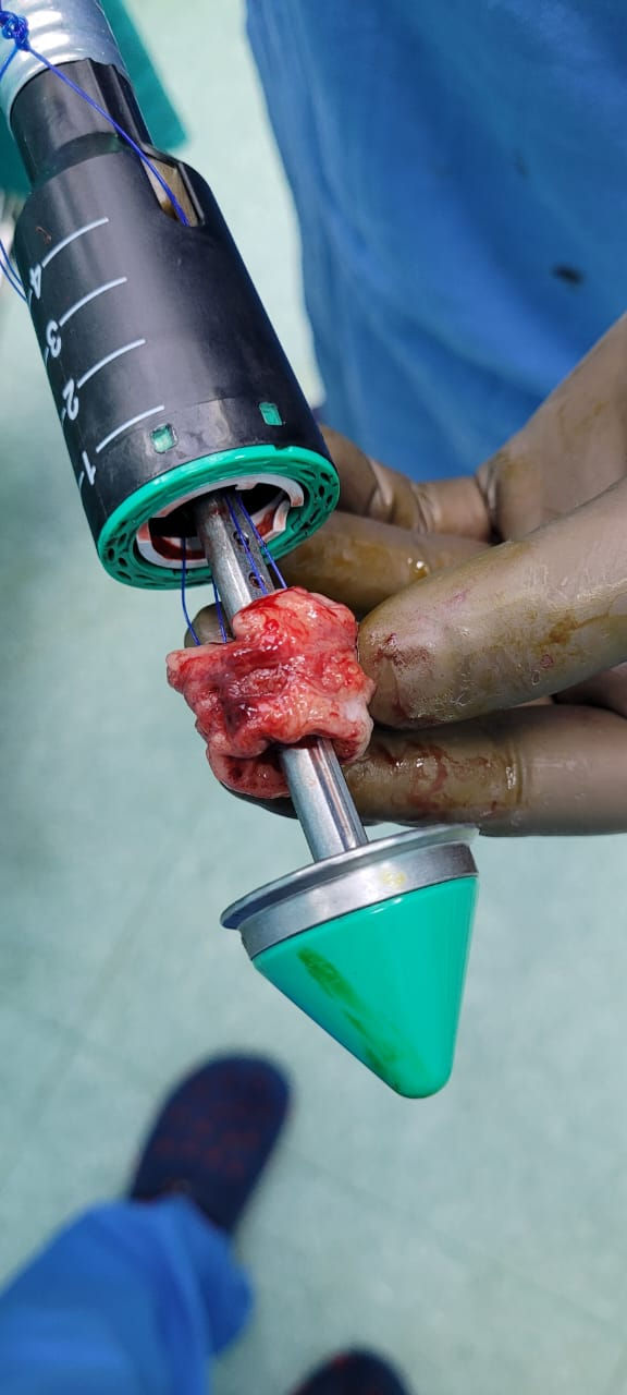 The Haemorrhoidal Doughnut After Excision