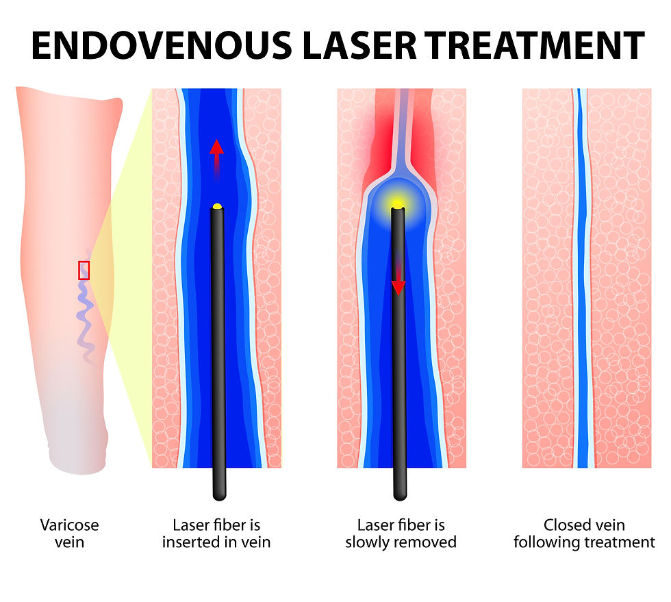 LASER INDUCED OBLITERATION OF VARICOSE VEINS
