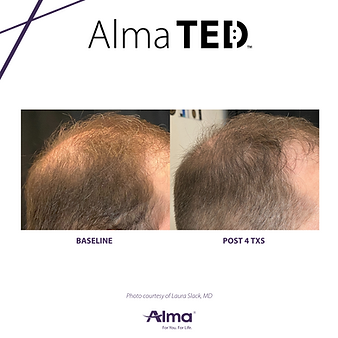 TED hair restoration man before and after photos