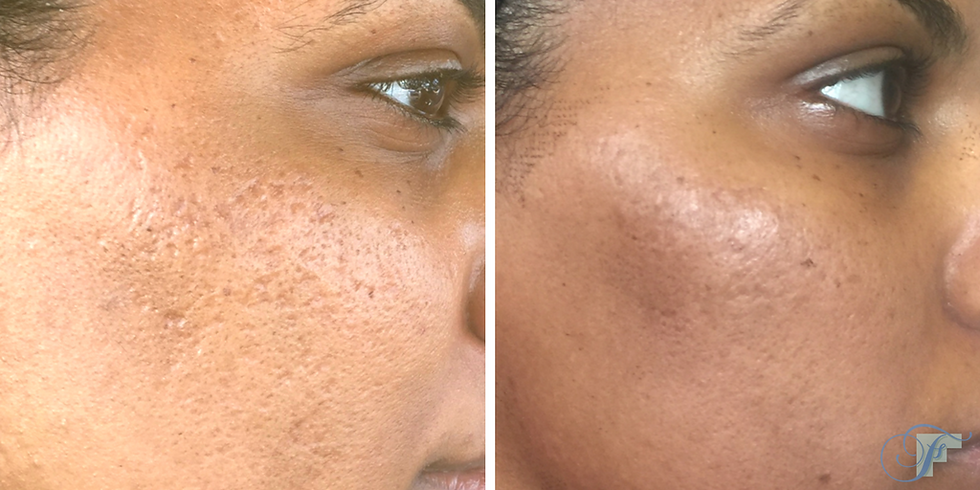 Before and After Pixel Skin Resurfacing