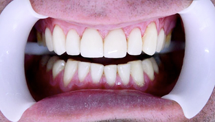 O que são Facetas de Porcelana?