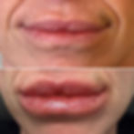 dermal lip fillers moi health and wellness m.JPG