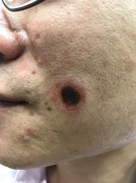 亂買來路不明「點痣膏」,造成皮膚壞死